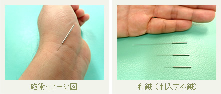 鍼経0.18㎜～0.30mm
